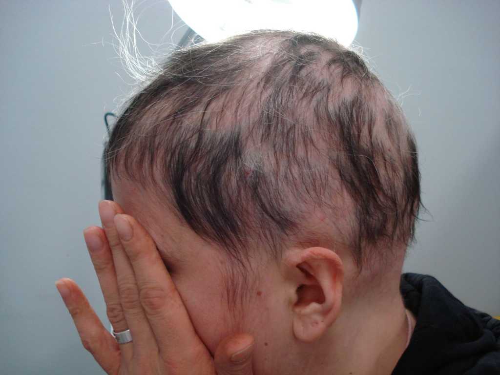 Alopecia androgenetica totale